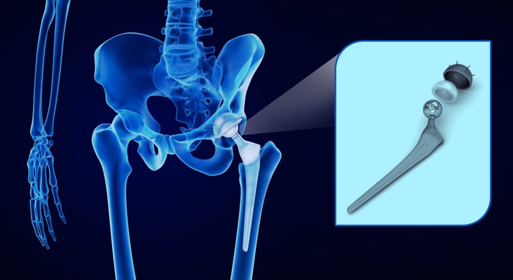 x-ray of skeleton with metal-on-metal hip implant
